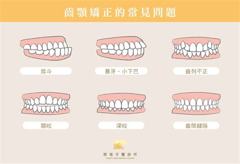 上下排牙齒平行|咬合不正怎麼辦？會影響臉型？原因、矯正方式一次看。